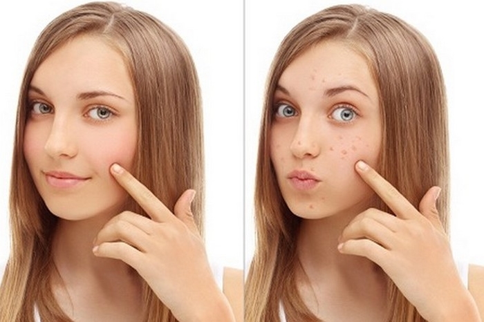 Cara menghilangkan flek hitam di wajah