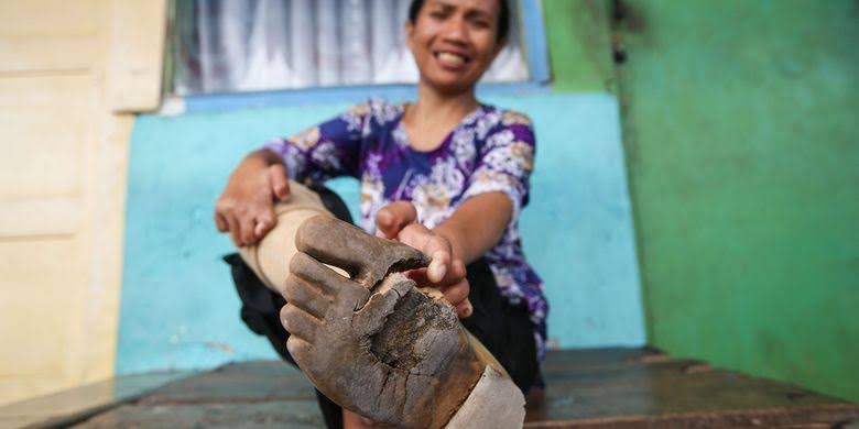 Gejala penyakit kusta